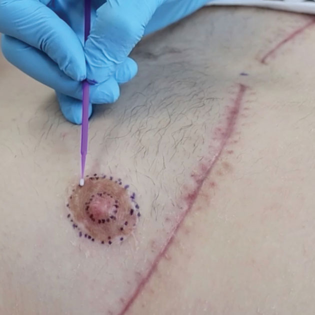 Vorbereitung einer Brustwarzen Rekonstruktionstätowierung medical tattoo